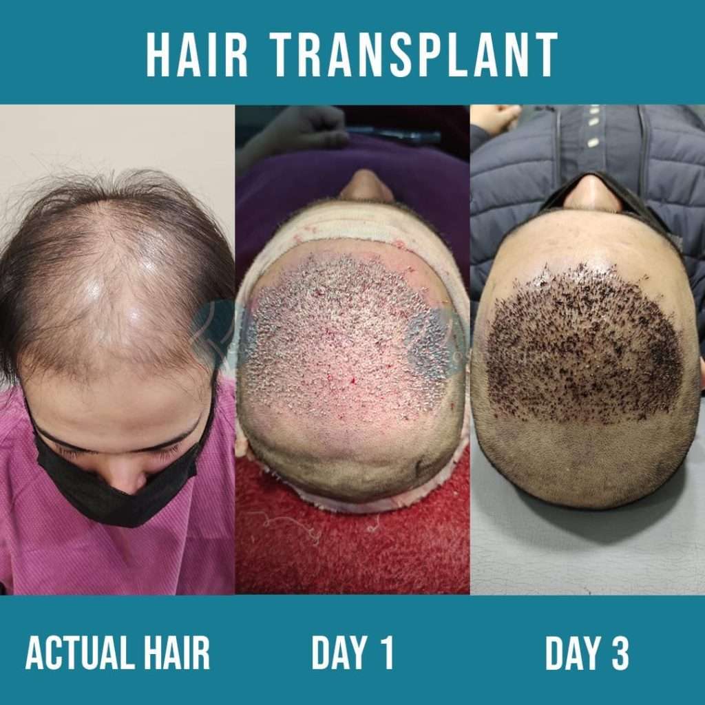 Hair Transplant in Lahore